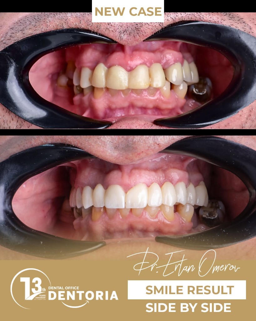 Before and after upper teeth restoration at Dentoria