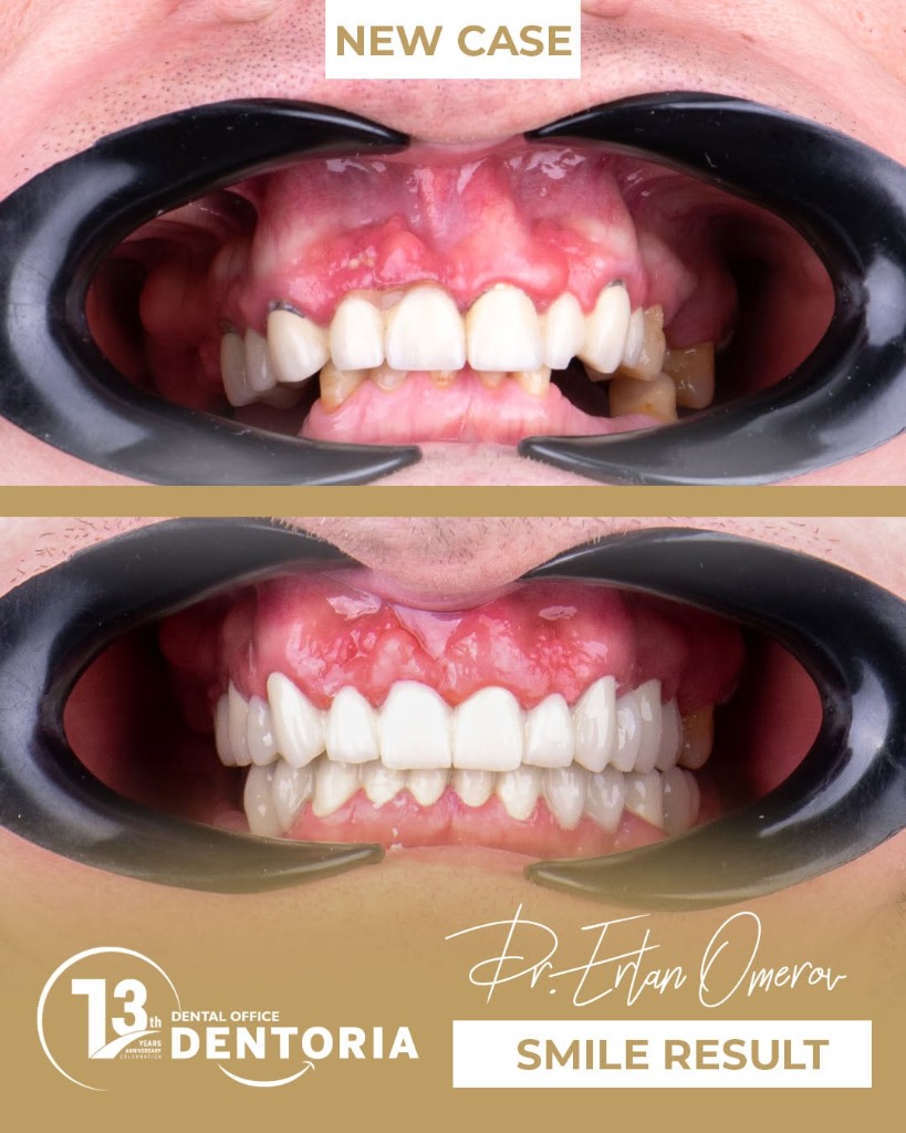 Before and after smile makeover at Dentoria